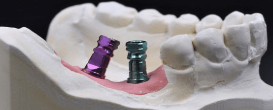 Utilisation clinique du coping de prise d'empreinte ouverte avec vérification directe de l'ajustement